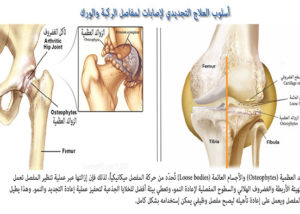 الفرق بين العلاج التقليدي والتجديدي لتمزق الغضروف الهلالي